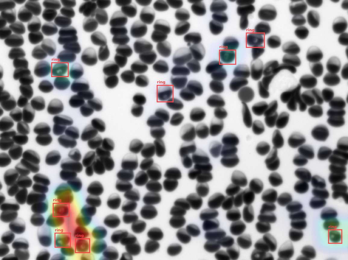 Malaria infected RBCs