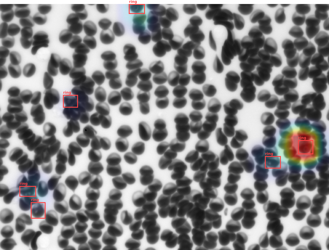 Malaria P. falciparum
