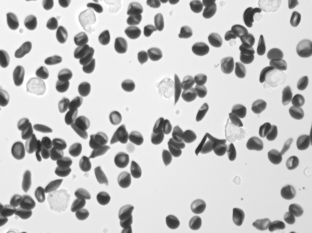 Sickle cells