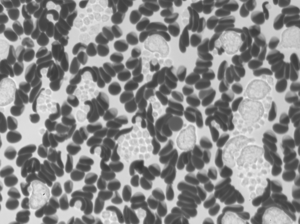 Thrombocytosis
